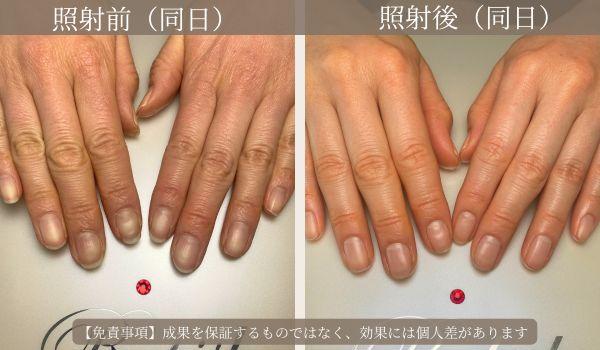 ルビッシュ体験された比較症例3